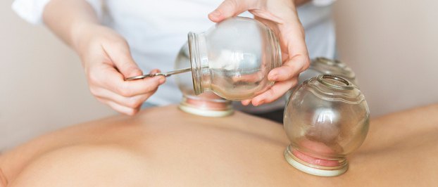Ventouses de verre posées sur le dos, au cours d'une séance